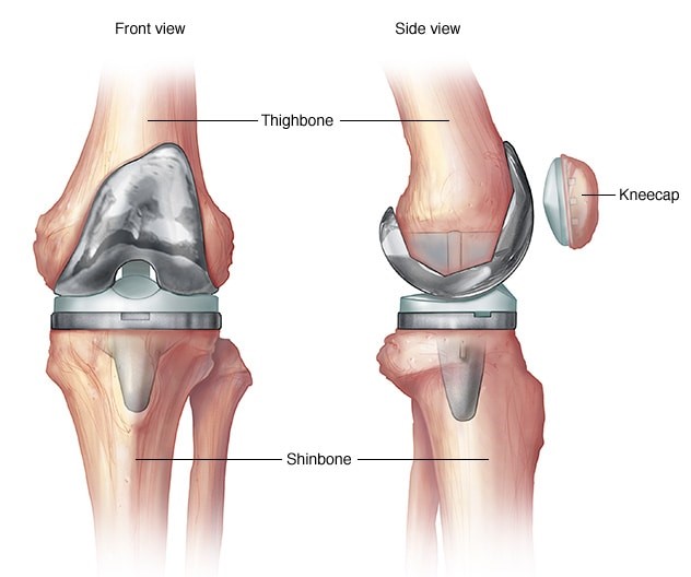 Knee-replacement